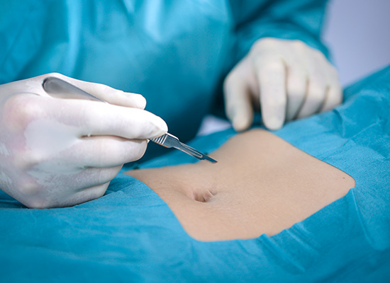 Bild von Skalpell vor Bauchdecke